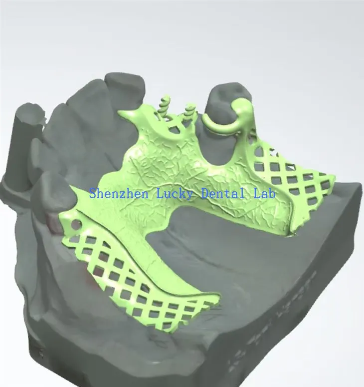 יצרני מסגרות מתכת שיניים תלת מימדיות