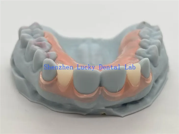 3D Print Dental TCS שיניים תותבות חלקיות גמישות