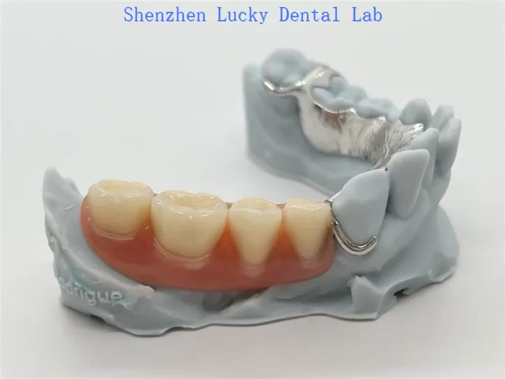 הדפס תלת מימד של Metal Co Cr Framework עם שיניים תותבות אקריליות