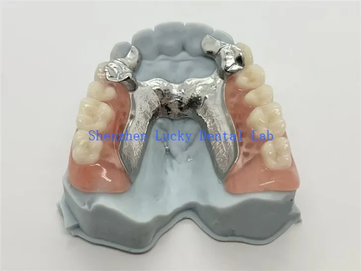 תותבת חלקית מתכת הדפסה תלת מימדית עם גיבוי שיניים מסגסוגת