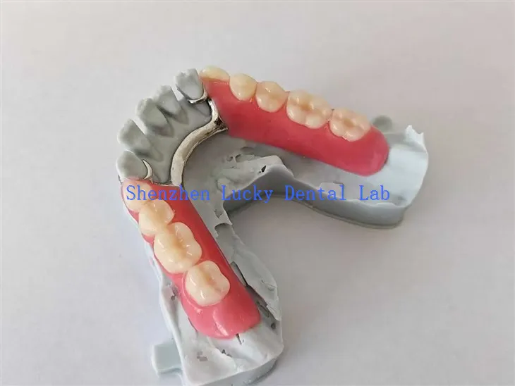 תלת מימד תותבת אקרילית חלקית עם מסגרת מתכתית נסה במעבדת שיניים