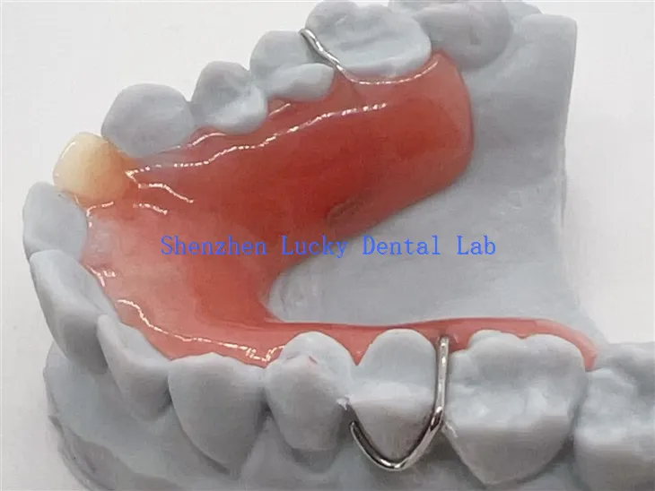 תותבת חלקית נשלפת בהדפסת תלת מימד עם בסיס אקרילי