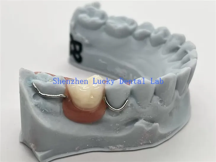 תותבת אקרילית חד צדדית להדפסת תלת מימד