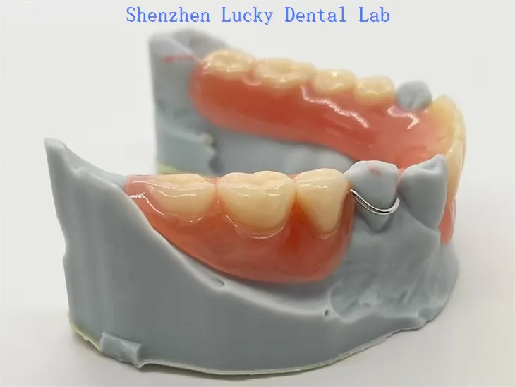 תותבת חלקית נשלפת אקרילית עם אבזם תיל