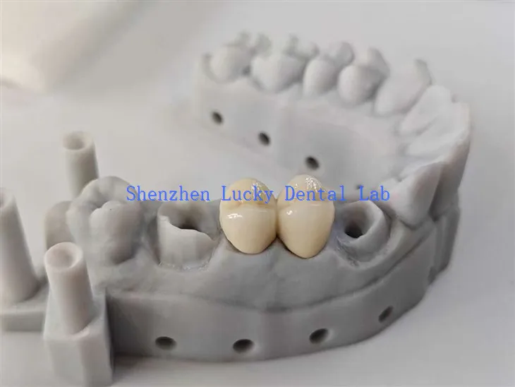 שיניים אסתטיות PFM גשר COCR