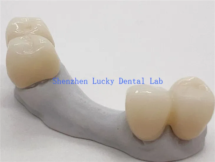 גשר זירקוניה שיניים אסתטי