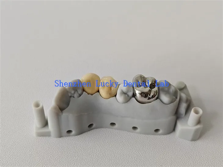 אסתטי תלת מימד הדפס FMC ו- PFM Cocr Crown שנעשה בסין