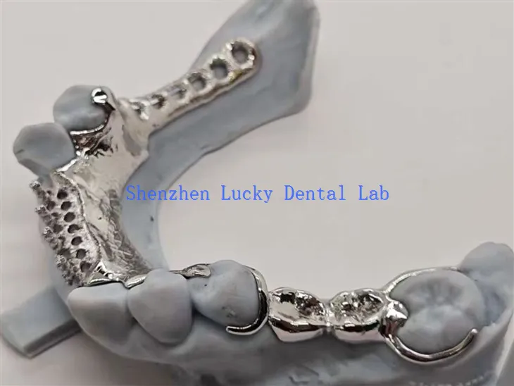 עיצוב שן מגובה בסגסוגת עם מסגרת מתכת