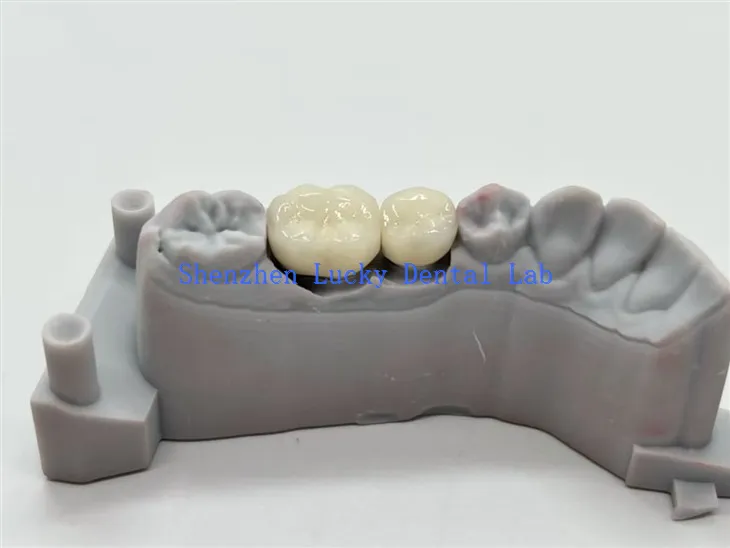 כתרי שיניים CoCr Alloy PFM