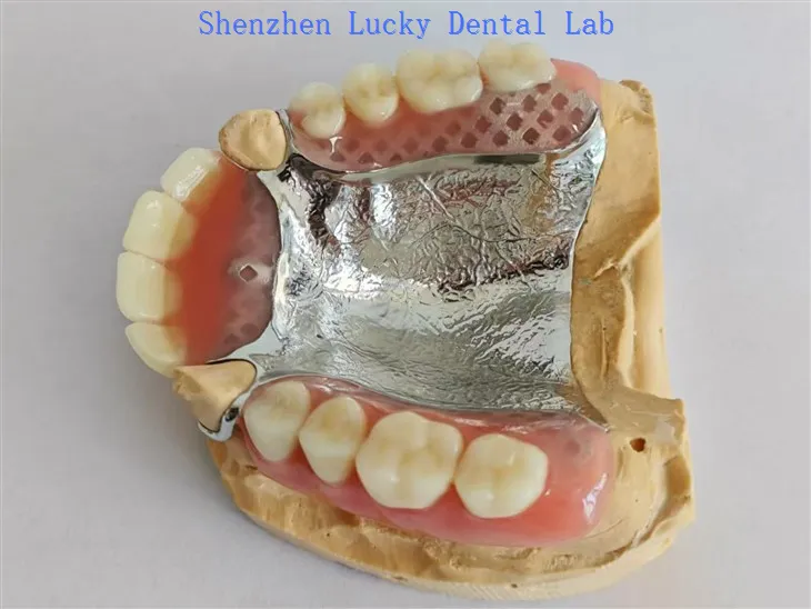 תותבת אקרילית חלקית בהתאמה אישית עם מעבדת שיניים של צלחת מתכתית