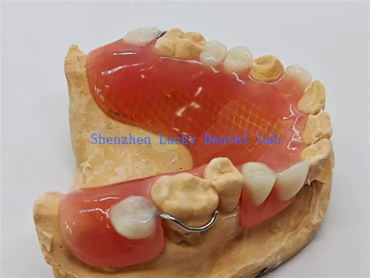 תותבת חלקית נשלפת עם רשת מתכת