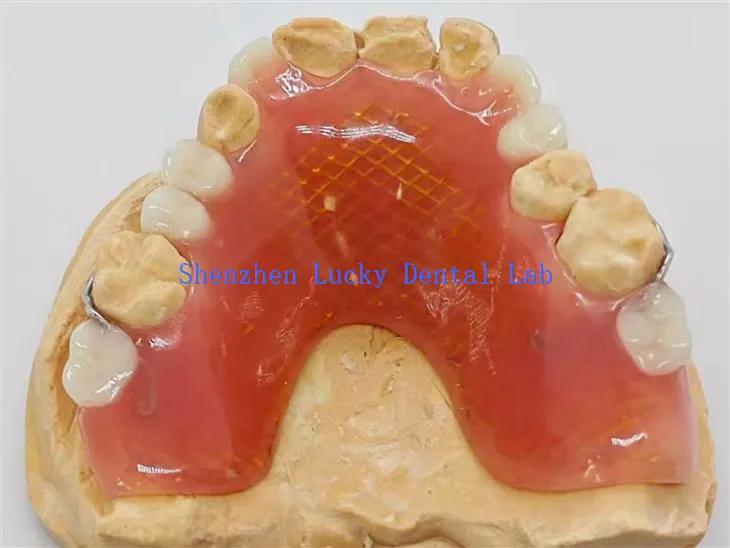 תותבת אקרילית חלקית שיניים עם מעבדת שיניים של רשת מתכת