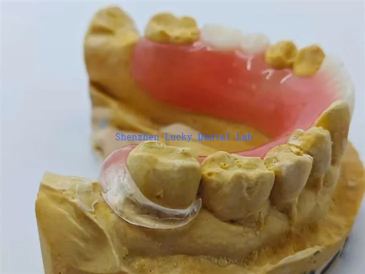 תותבת אקרילית עם אבזם ברור