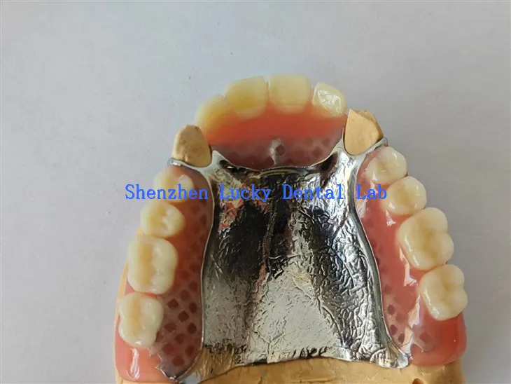 תותבת אקרילית חלקית נהדרת עם מעבדת שיניים צלחת מתכתית