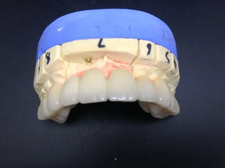 דנטל דיוק גבוה כתר זירקוניה קרמי