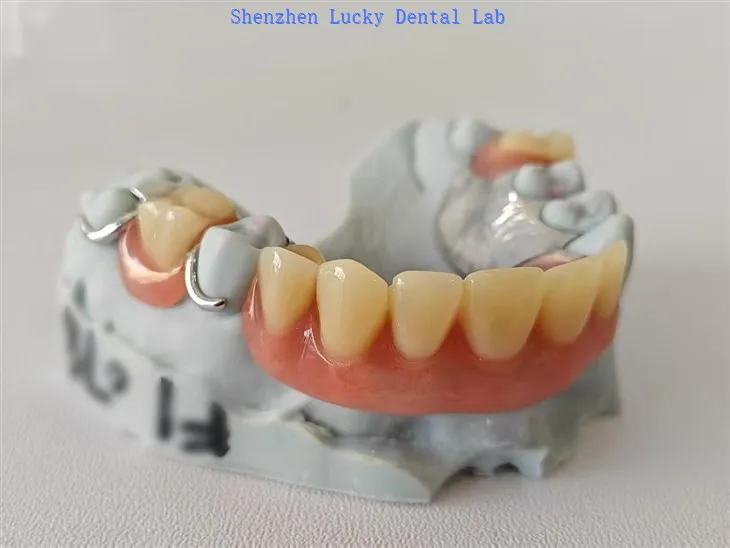 תותבת אקרילית חלקית עם מסגרת מתכת של אבזם חוט