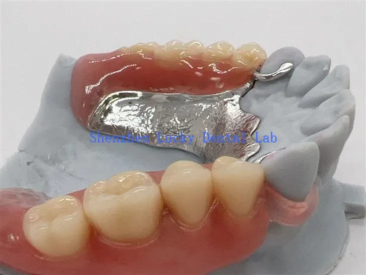 מסגרת מתכת של Valplast Clasp עם תותבת אקרילית