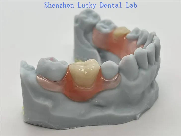 חלקים Valplast® עם אבזם גמיש