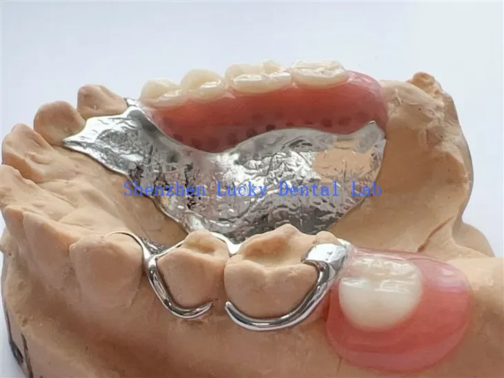 מסגרת מתכת דנטלית עם אבזם תיל עם תותבת אקרילית חלקית